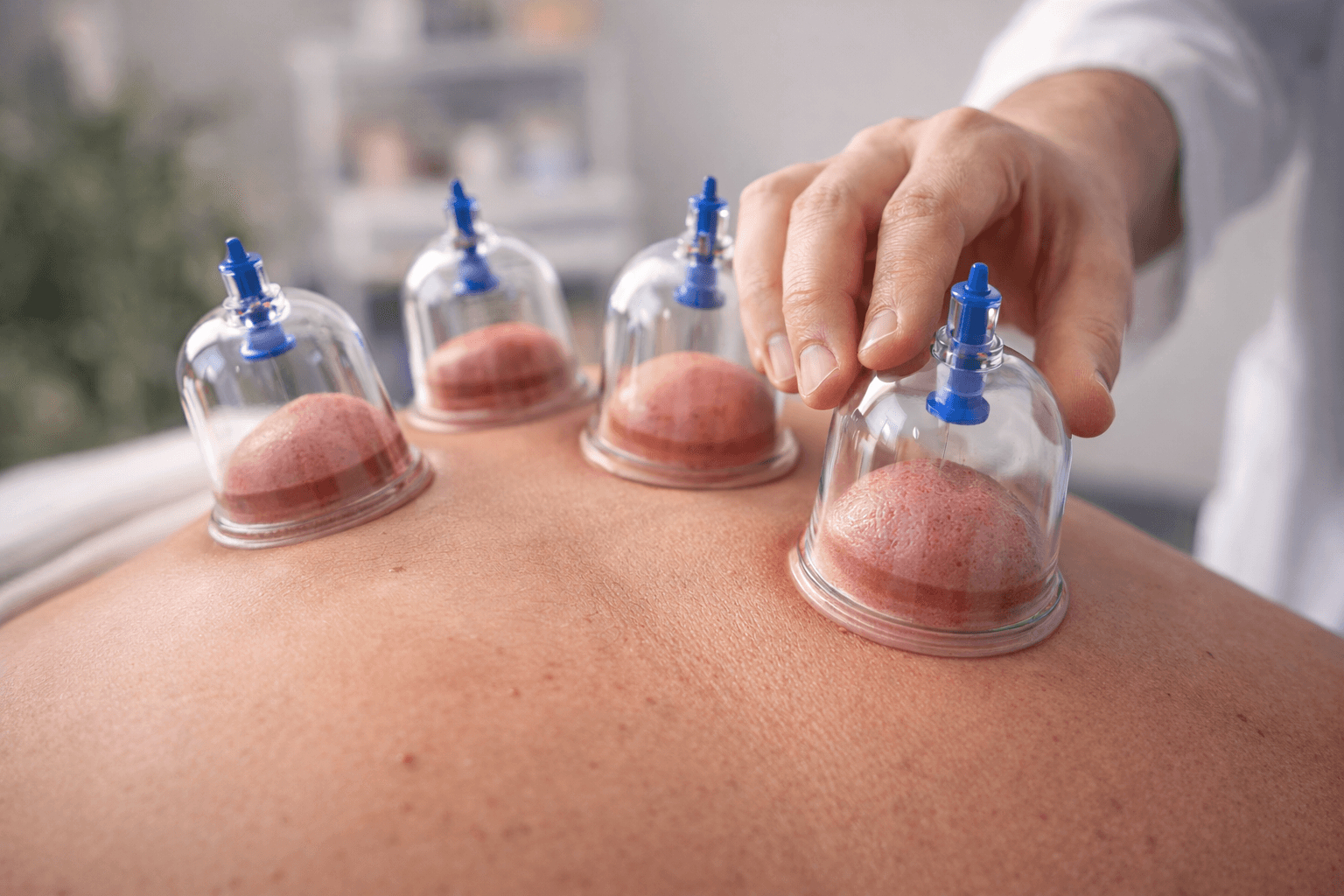 Hijama / Cupping Therapy